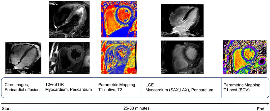 ASDAS states in patients stratified by baseline MRI/CRP status.
