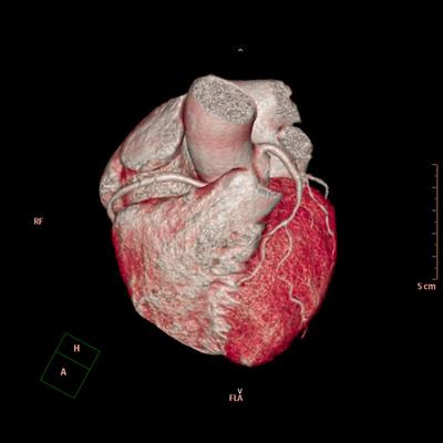 Cover image for research topic "Aortopathy in Congenital Heart Disease"