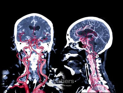 Cover image for research topic "Search for optimal treatment for MeVO; thrombectomy, thrombolysis, adjunctive therapy"